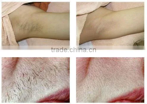 Portable Long Pulse Reduce Hair Removal Equipment/ varicose treatment