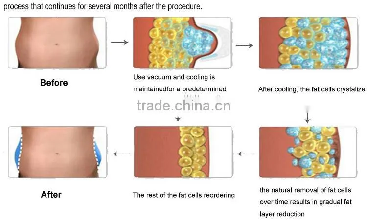 Home Use Suppliers Cool Tech Fat Freezing Machine For Fat Burning