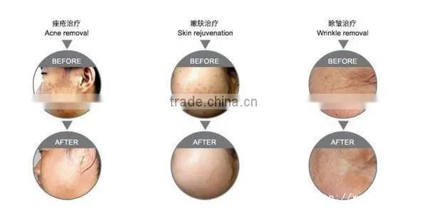 Hot Selling in USA Mini Red/Blue Light Machine For Skin Care, Skin Tighten, Acne Treatment/LED Light Therapy Machine