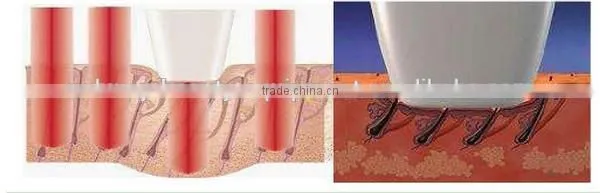 2014 most popular laser hair removal hair removal brown/alma laser hair removal machine for sale