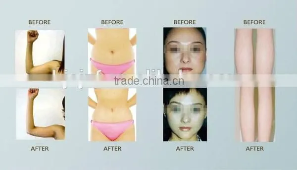 SL-2 New medical devices 2016 Unique cold sculpting cryotherapi cool slim CE approved