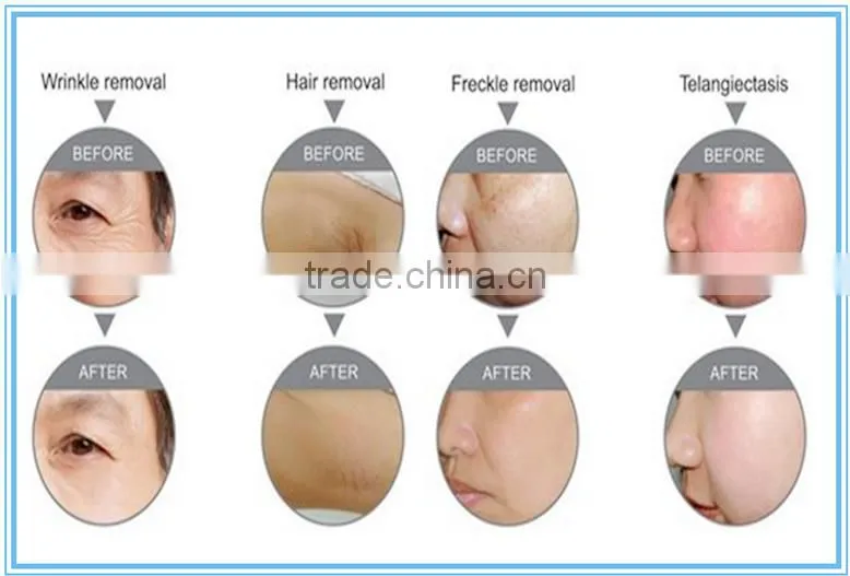 Permanent laser hair removal 808nm e light hair removal machine