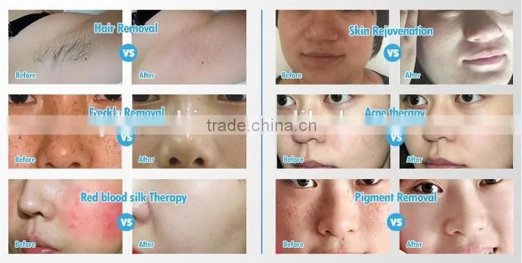 CE approval opt shr hair removal e light ipl portable