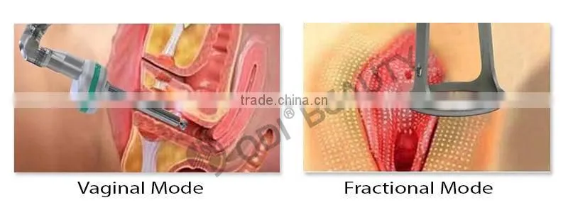 OD-V8 Professional fractional co2 laser treatment with beautiful vaginas