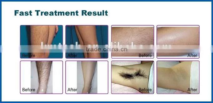 Safety 808nm laser diode hair removal without pain
