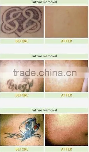 2012 Portable ND-YAG Laser Eyeliner Tattoo Removal