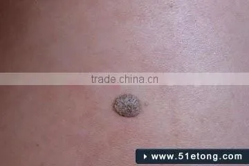 Micro Portable Handhold freckles removal pen