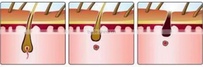 CE Certificated permanent hair removal SHR OPT IPL permanent hair removal laser in alibaba