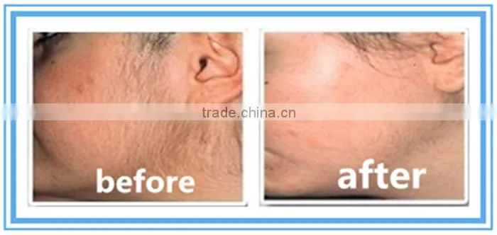 professional laser hair removal machine for sale