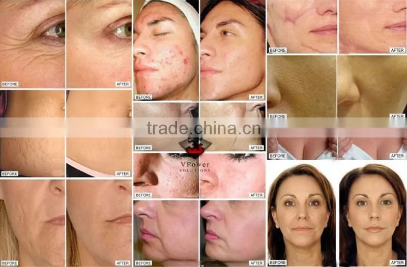 2016 Korea Stype LED Mask Neck Photon / LED Facial Mask / PDT lamp