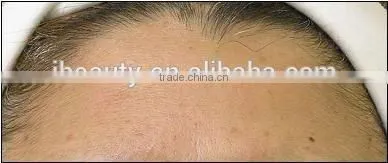 2016 MR16-2SB New product microneedle /auto micro needle therapy system