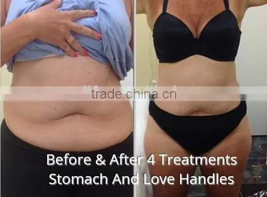 NL-LSR900 Laser ultrasonic cavitation body slimming machine with Bipolar Tripolar RF and 650 nm Laser for fat burning body slim