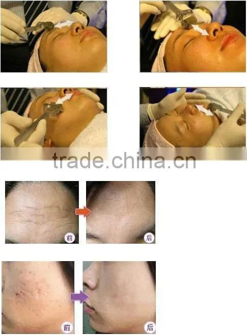 dmicro needle derma roller anti aging anti hair removal L005 CE