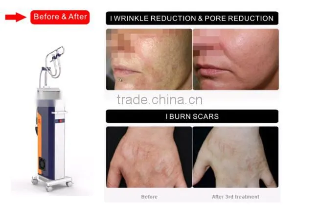 Micro-Needle RF scar and wrinkle removal equipment -MNF100