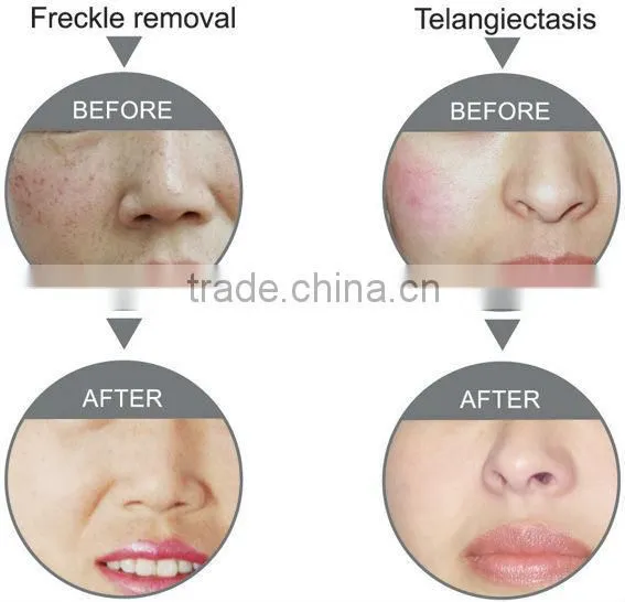 High performance chinese Multifunctional beauty machine