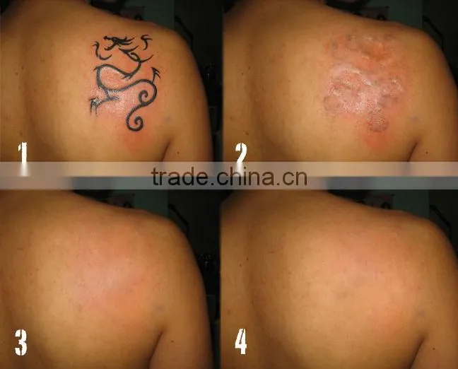 portable depilacion laser with CE approval