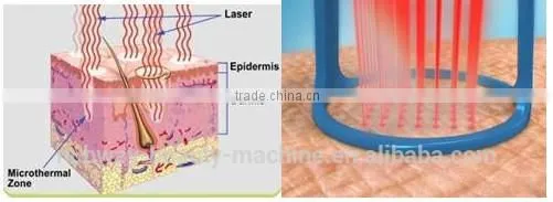Effectively Best Quality Professional Clinic Use Fractional CO2 Laser Acne Scar Removal
