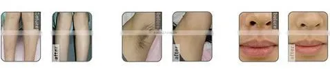 Hot sale! Most advanced beauty salon/spa use newest 808nm diode laser with CE