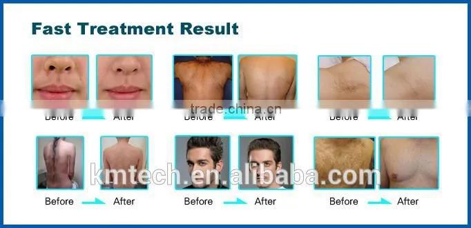Cavitation Bipolar RF Elight IPL Nd-Yag Electrical Multi-application Personal Care Product
