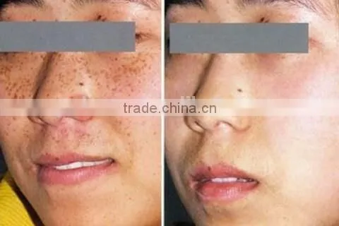 Safe painless 6 in 1 elinght rf ipl skin rejuvenation hair removal machine