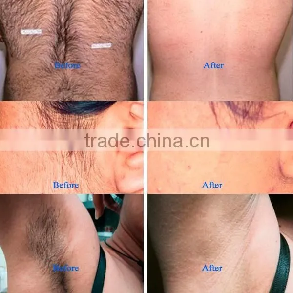 real sapphire crystal shr ipl face treatment home use beauty equipment