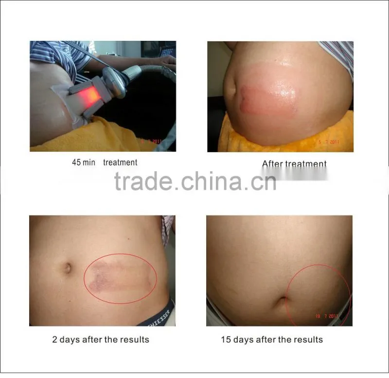 cryolipolysis machine training