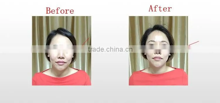 Obvious effect ! Body Contouring Face Lifting thermal RF