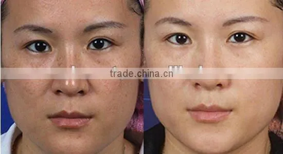 2012 Newest IPL+RF Elight machine for red capillary and acne treatment