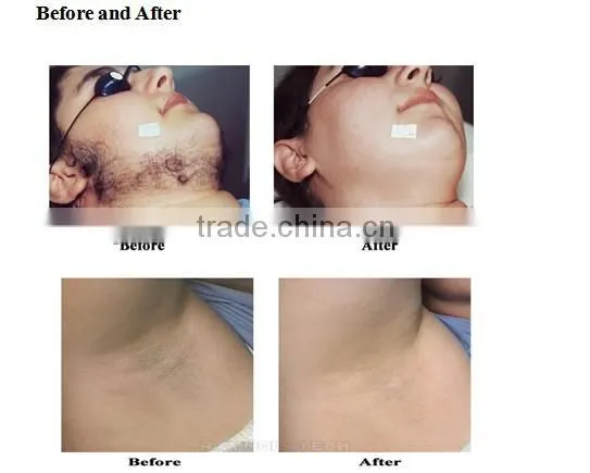 2015 Hot Sale in Clinic Permanent Hair Removal Machine IPL
