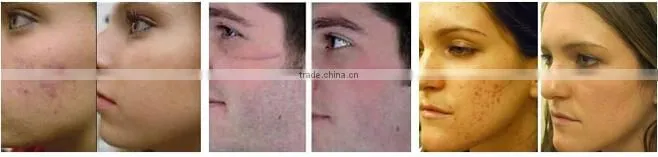 2015 fractional co2 laser 30w acne scar removal/fractional co2 laser equipment