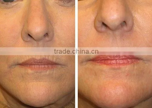 Vagina Rejuvenation CO2 Fractional Laser Skin Rejuvenation