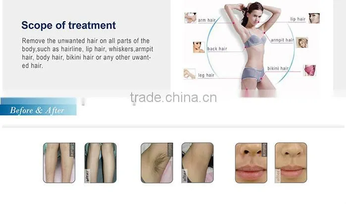 Alexandrite laser 755nm epila laser hair removal machine price in india