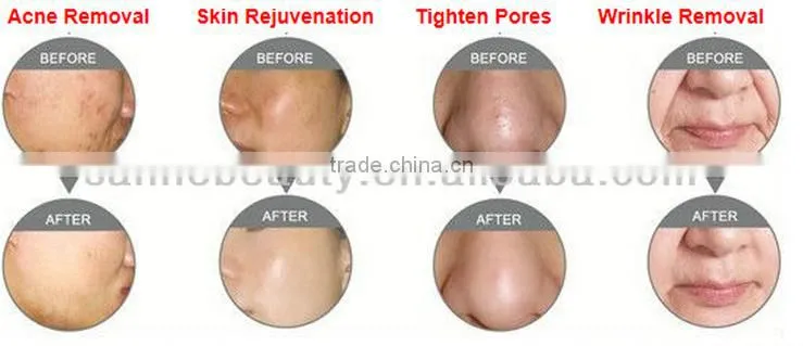40W RF Tube Laser Generator Vaginal Tightening CO2 Laser Fractional Beauty machine