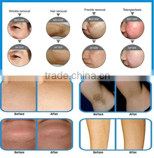 new!!! portable E-light beauty equipment IPL hair removal for beauty salon MB-L215