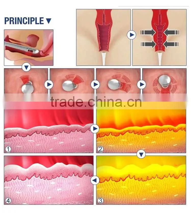 2016 Good effect 25mm focal length hifu vaginal tightening machine with CE certificate