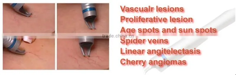 Spider vein vascular removal 980nm diode laser for Age spots and sun spots treatment