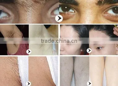 beauty machine shr ipl elight permanent hair removal machine