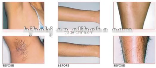 2014 hotsell co2 fractional laser beauty machine