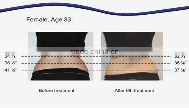 lipolaser body slimming machine, lipolaser slimming machine diode laser