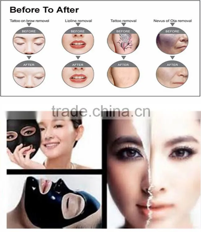High Quality Double Rod Powerful Q-switched Nd-yag Laser