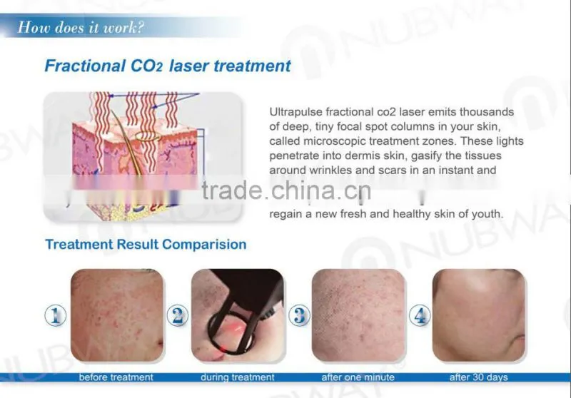 Vertical 40W Medical CE approved RF Pipe Fractional co2 laser pigment removal Gynecology treatment laser equipment