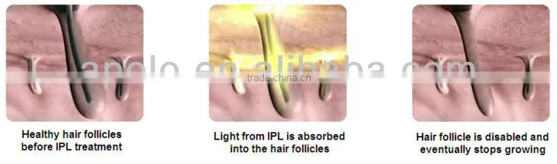 photoepilation machine e-light HS 300C photo epilation equipment Ipl Photo Rejuvenation by shanghai med apolo medical technology