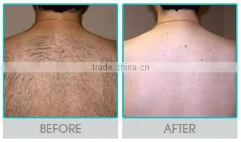 Professional FDA approved ipl photorejuvenation machines