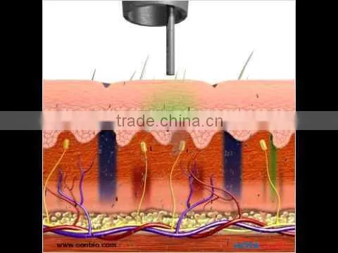 EO Q switch ND: YAG LASER1