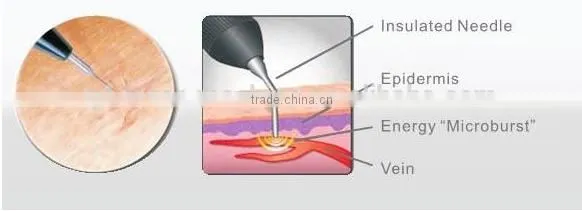 Hot Selling !! Vein Wave Machine