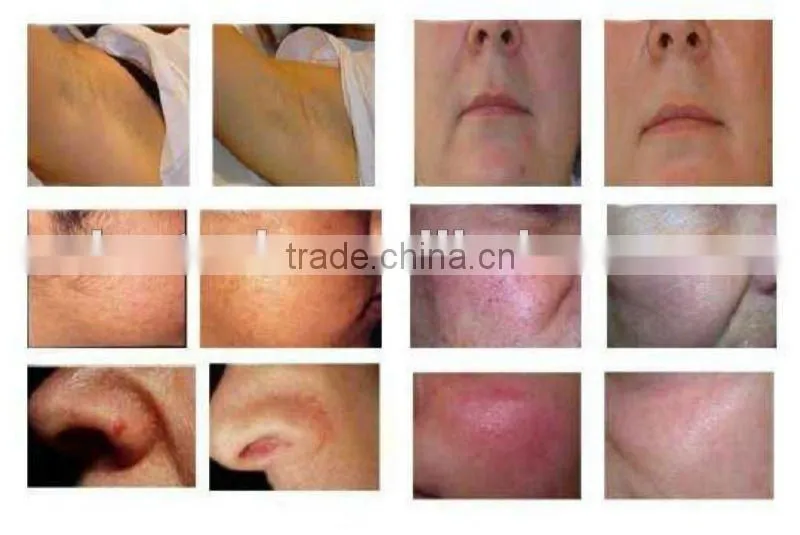 2013 New Portable ipl machine manufacturers looking for distributer