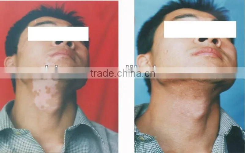 epidermis transplantation vitiligo cure machine