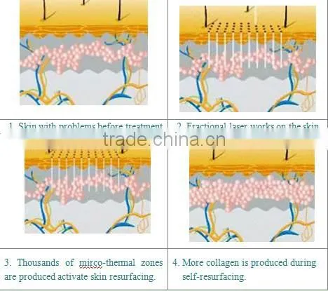 100% High Quality Skin Resurfacing Acne Scar Removal Fractional Co2 Laser Equipment