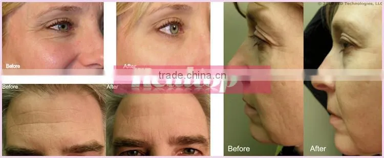 Korea RF beauty machine radio frequency facial machine for home use skin tightening