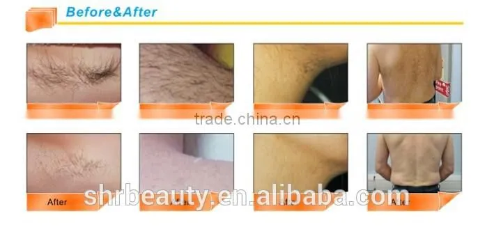 2016 New designed two handles vertical elight IPL SHR Fast Hair Removal beauty machine wholesale ipl hair removal